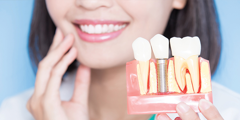 Revolutionize Your Smile with Dental Implants: Discover the Potomac Crown Dentistry Difference